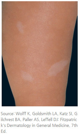 결절성경화증의다른증상-마포공덕 에스앤유피부과.jpg