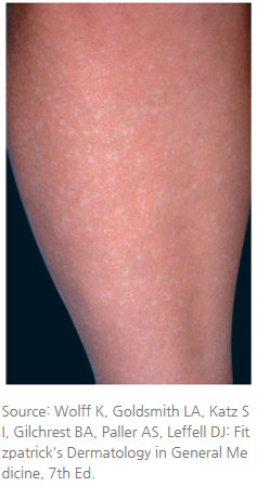 결절성경화증의다른증상-마포공덕 에스앤유피부과1.jpg