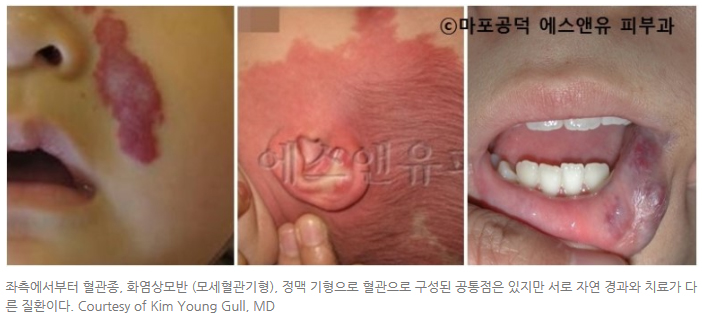 혈관종-마포공덕에스앤유피부과.jpg