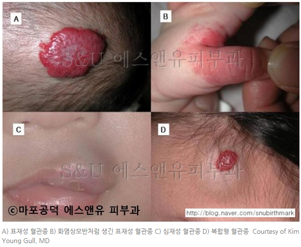 혈관종-마포공덕에스앤유피부과1.jpg