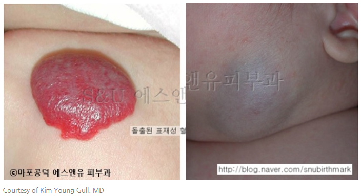 혈관종의 바르는약-마포공덕에스앤유피부과.jpg