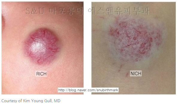 선천성혈관종에 대한고찰-마포공덕에스앤유피부과.jpg