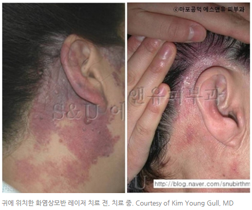 화염상모반과 동반되는 동맥기형-마포공덕에스앤유피부과.jpg