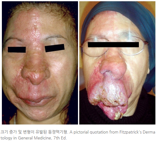 화염상모반과 동반되는 동맥기형-마포공덕에스앤유피부과1.jpg
