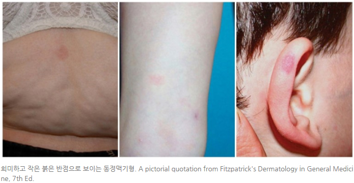 화염상모반과 동반되는 동맥기형-마포공덕에스앤유피부과2.jpg