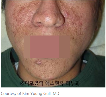 결절성경화증 혈관섬유종-마포공덕에스앤유피부과.jpg