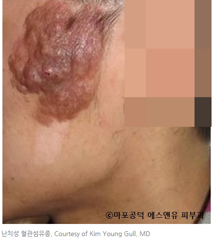 결절성경화증 진단-마포공덕에스앤유피부과.jpg