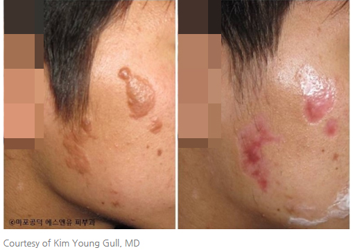 결절성경화증 치료-마포공덕에스앤유피부과1.jpg