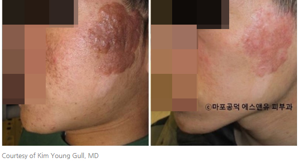 결절성경화증 혈관레이저-마포공덕 에스앤유피부과1.jpg