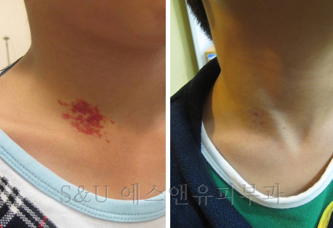 혈관종을 나이들어 치료하면-마포공덕 에스앤유피부과.jpg