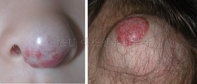 혈관종의 종류-마포공덕에스앤유피부과5-1.jpg