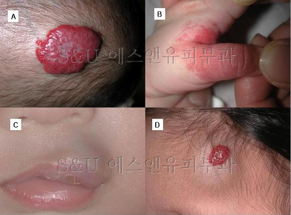 혈관종의 잘못된 정보-마포공덕에스앤유피부과.jpg