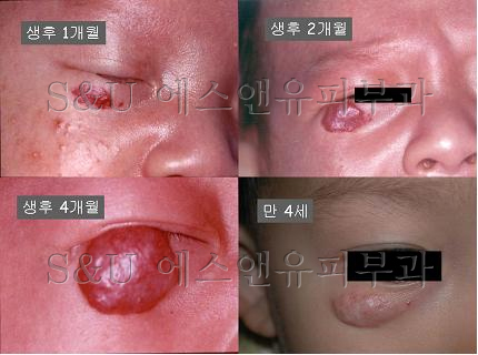 혈관종의 원인-마포공덕에스앤유피부과.jpg