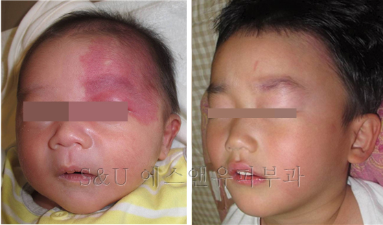 혈관종과 화염상모반-마포공덕에스앤유피부과.jpg