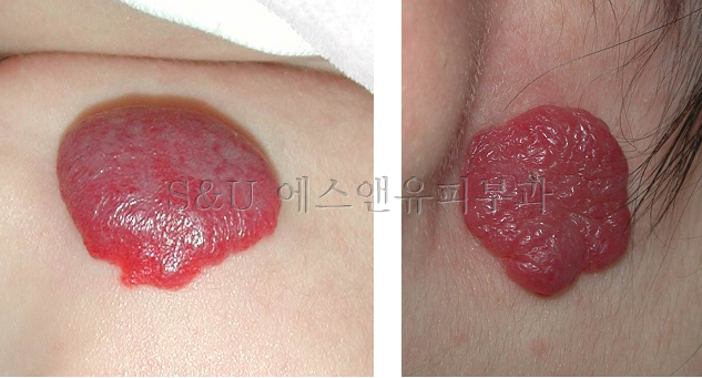 혈관종의 종류-마포공덕에스앤유피부과-1.jpg